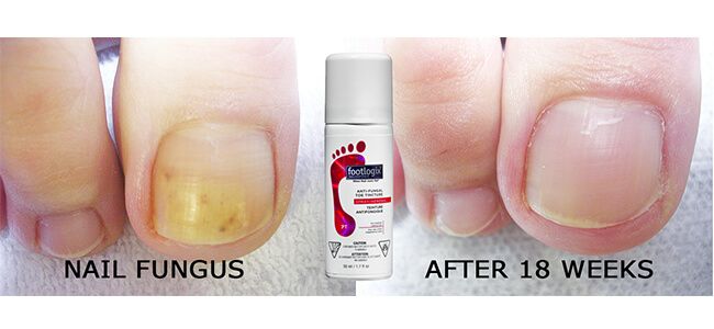 Fungal Nail Infection